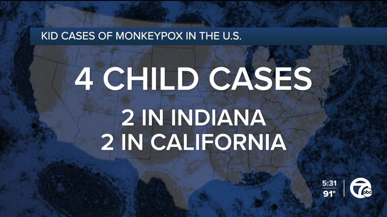 What parents should know as 5th child tests positive for monkeypox in US