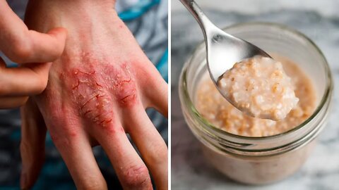 EsseTratamento Caseiro Pode Ajudar Seu Eczema