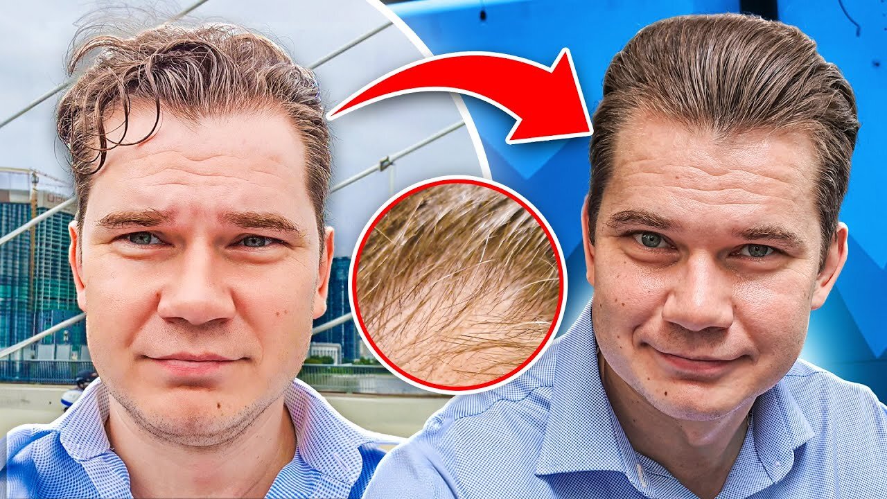 My Hair Has Been Shedding | Temple Recession Still On Treatment