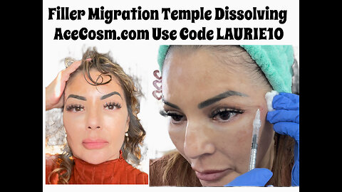 Filler, migration, temple dissolving