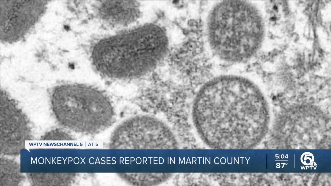 Compass Center holding discussion on monkeypox as cases grow