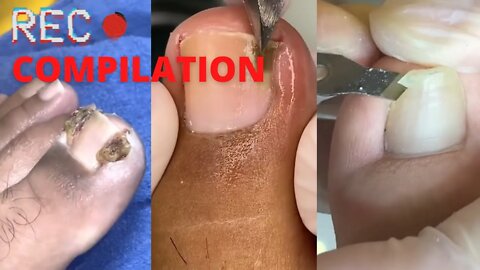 4 minutes of Ingrown Toenails Removal - Compilation