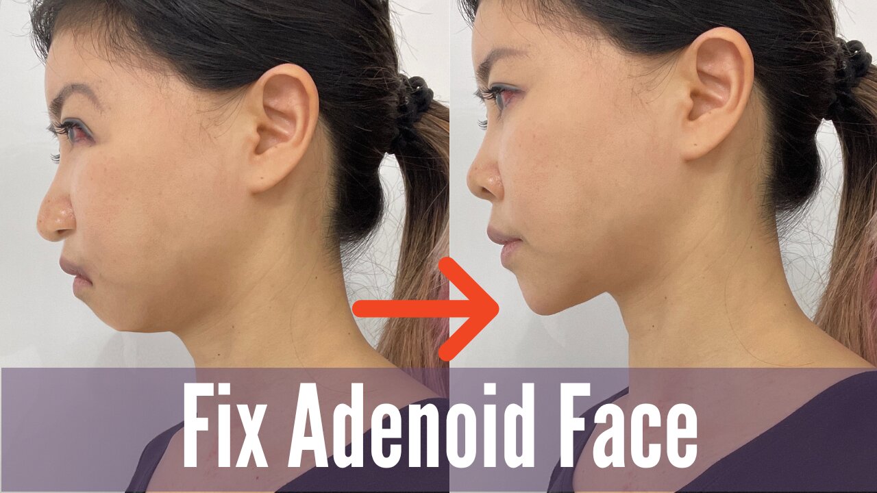 What Is Adenoid Face How To Improve