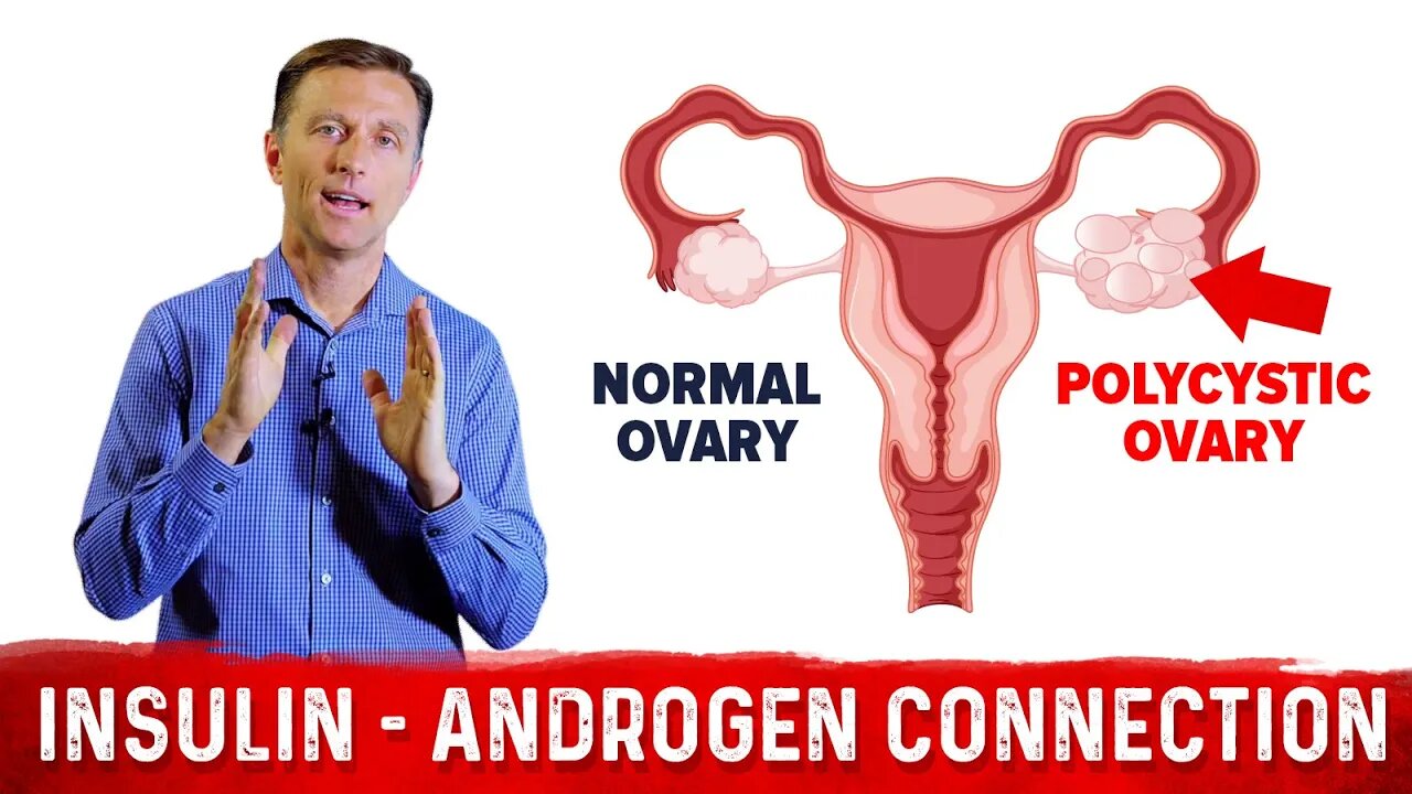 Why Does Insulin Cause PCOS (Polycystic Ovary Syndrome)? – Dr.Berg