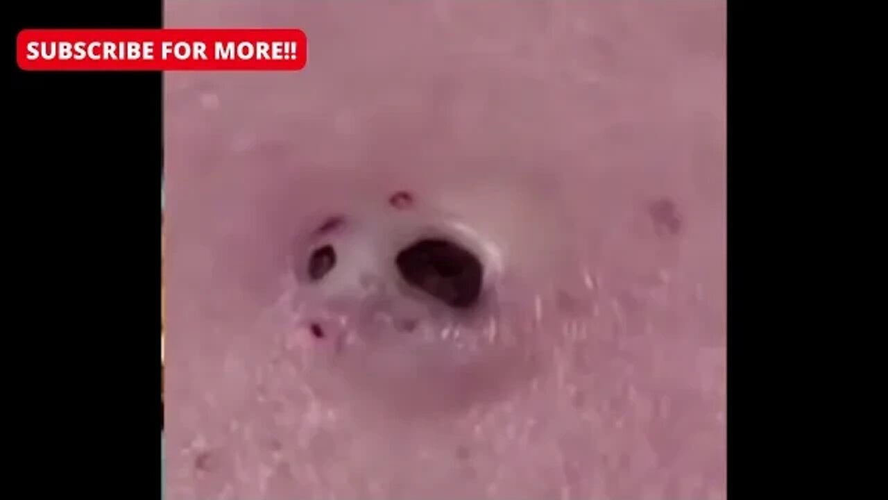 One of the biggest blackhead I've ever seen!! satisfying and relaxing!! Whitehead cravo pimple