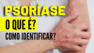 Psoríase - O que é e Como Identificar Psoríase