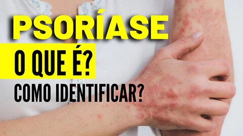 Psoríase - O que é e Como Identificar Psoríase