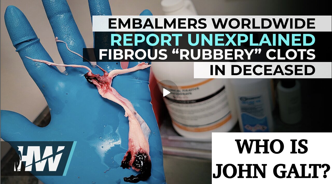 DEL BIGTREE-EMBALMERS WORLDWIDE REPORT UNEXPLAINED FIBROUS “RUBBERY” CLOTS IN DECEASED. TY JGANON