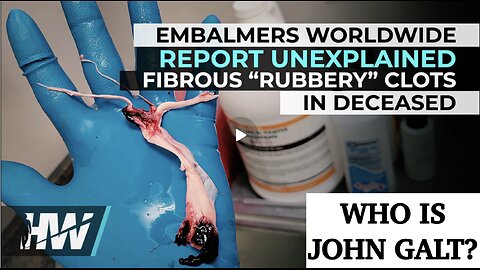 DEL BIGTREE-EMBALMERS WORLDWIDE REPORT UNEXPLAINED FIBROUS “RUBBERY” CLOTS IN DECEASED. TY JGANON