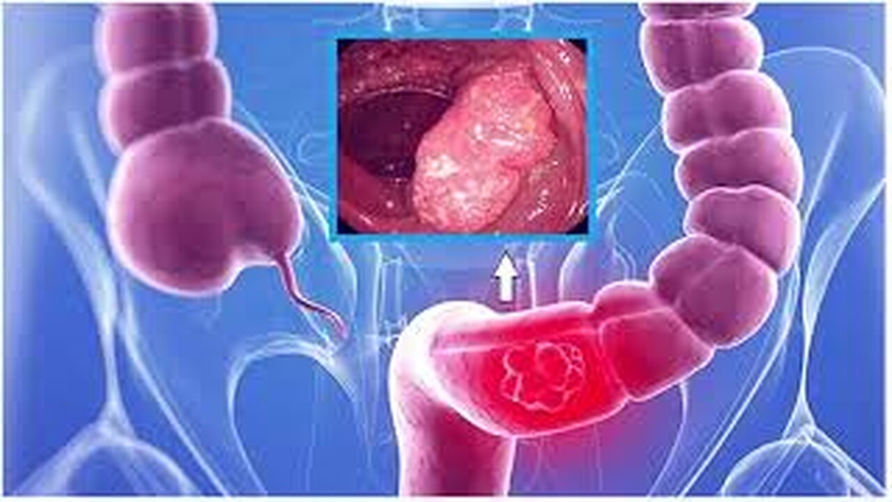 CANCER DE COLON BIODESCODIFICACION Y EL TRATAMIENTO