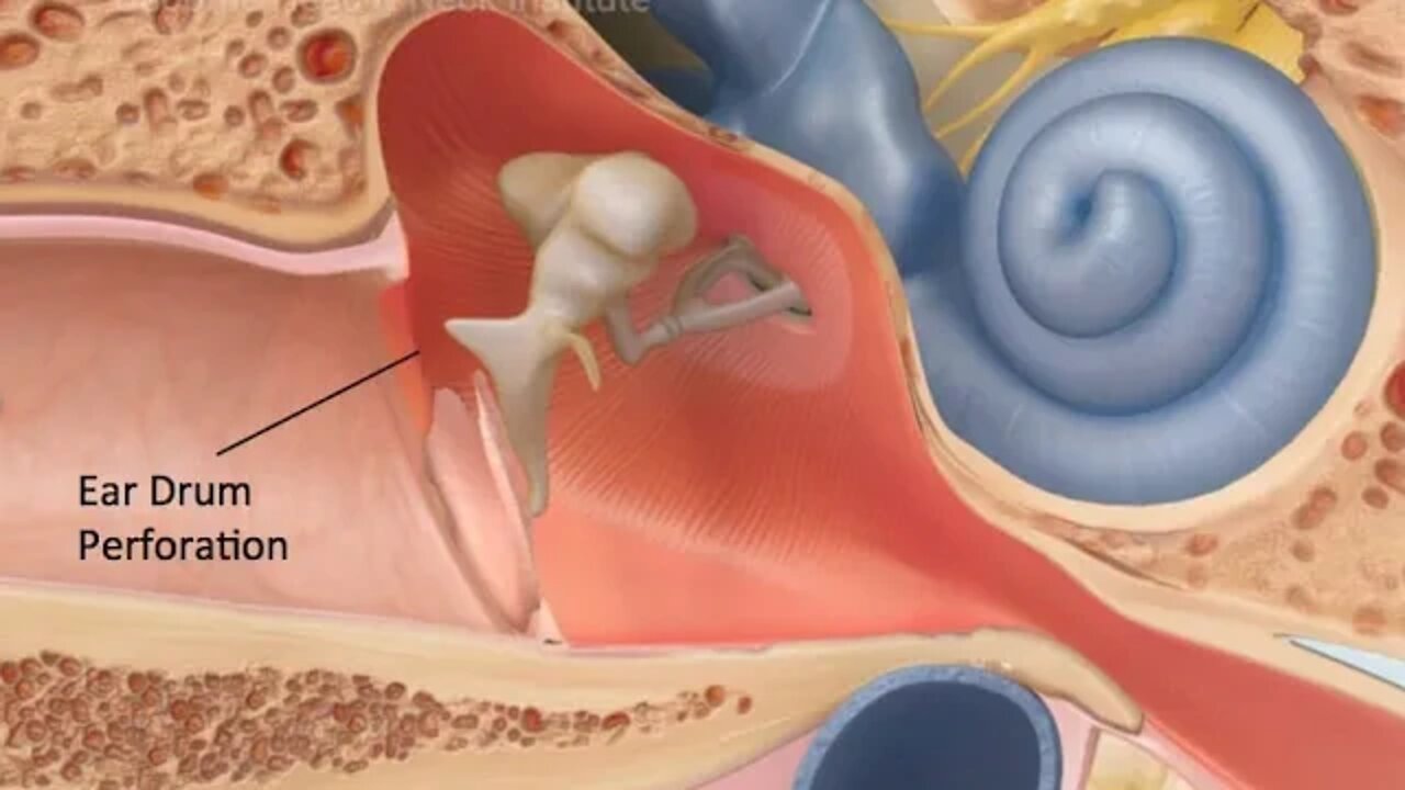 Furei Meu Tímpano e Agora O Que Fazer? Timpano Perfurado o Que Fazer