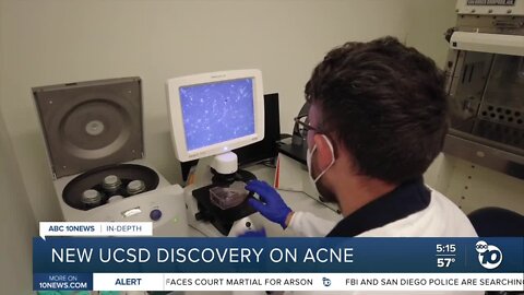 In-Depth: UCSD discovery could change acne treatment