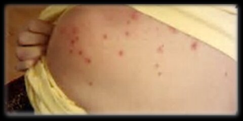 7. Rubella (measles)