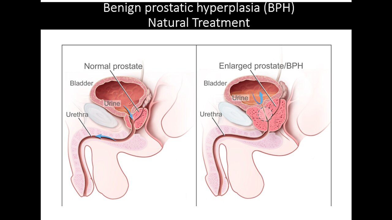 Benign Prostatic Hyperplasia - Natural Treatment