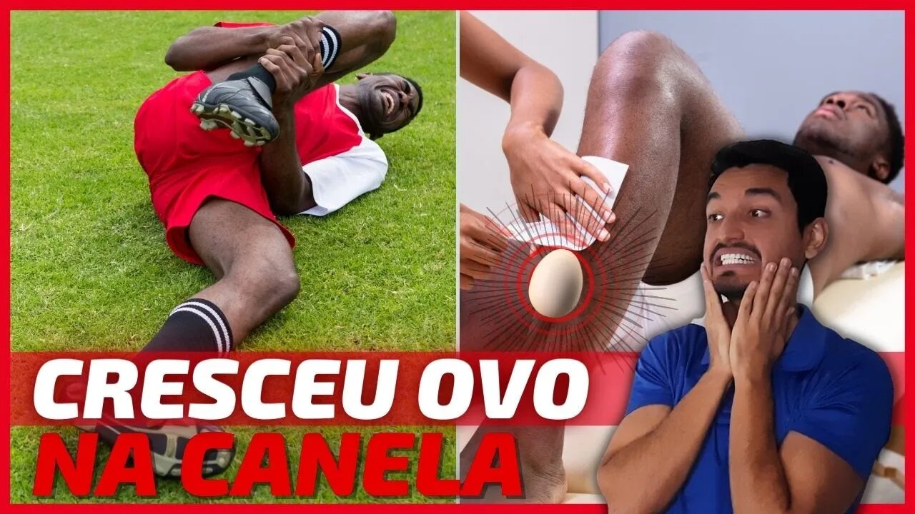 ✅Como Tratar Galo na CANELA?😱 Caroço na Canela após Pancada? 🕐Quanto TEMPO DURA um Galo na Canela?