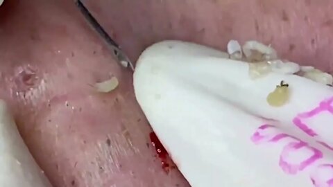 🦯🤢🥵 Remoção de cravos. Relaxante e satisfatório!! Blackhead removal