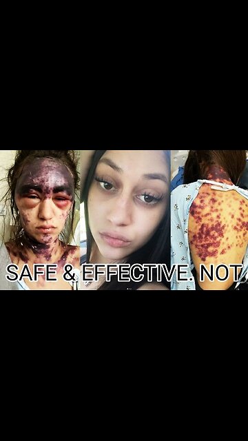 Safe and Effective. NOT... ALEXIS UPDATE