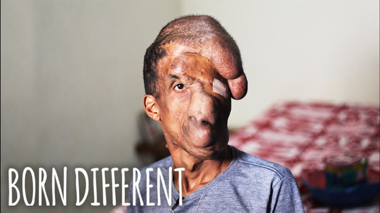 A Tumour Has Taken Over My Face | BORN DIFFERENT