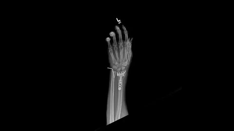 Wrist update
