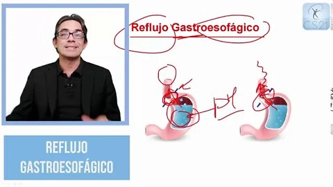 Reflujo Gastroesofágico: lo que debes saber.