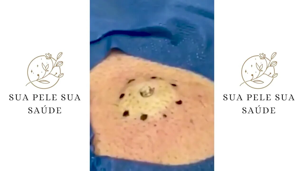 Satisfactory Video Blackhead Removal Skin Cleansing #24 | 2022 Video