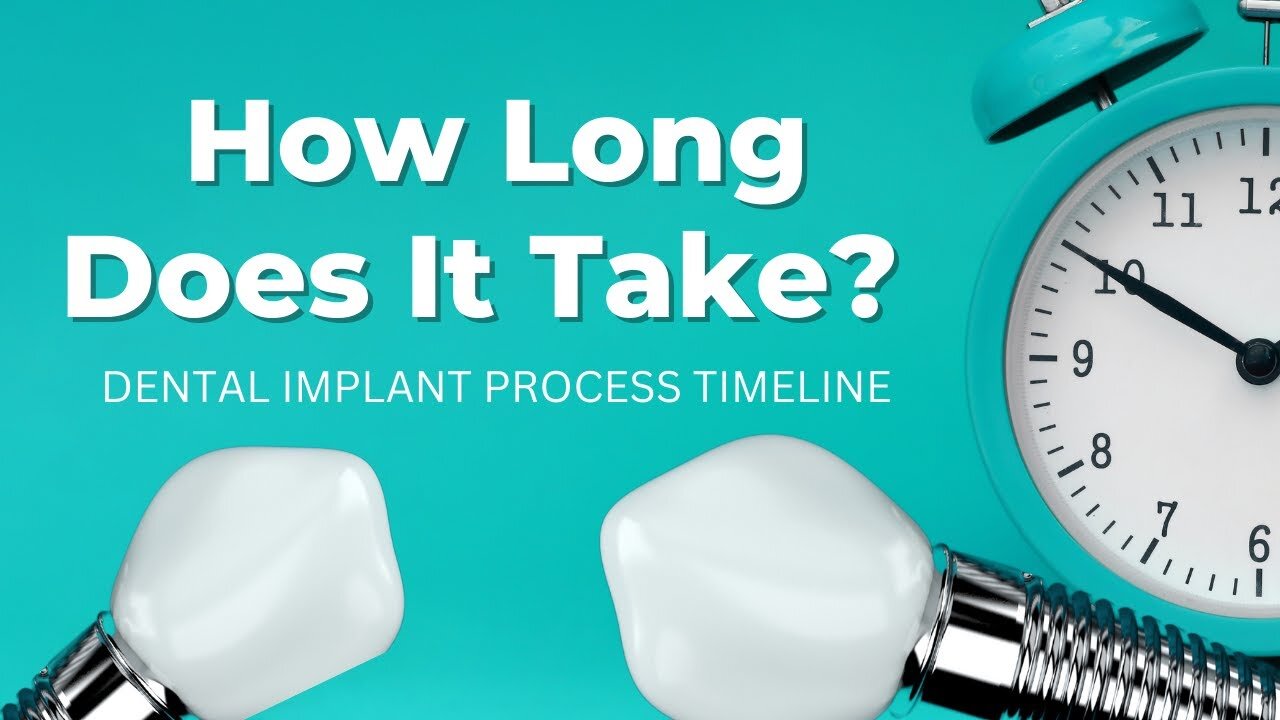 The Dental Implant Process: How Much Time Does It Really Take?