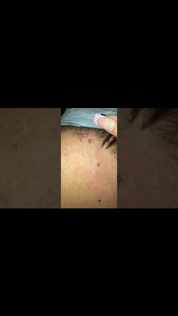 Enormous Ingrown Hair Removal