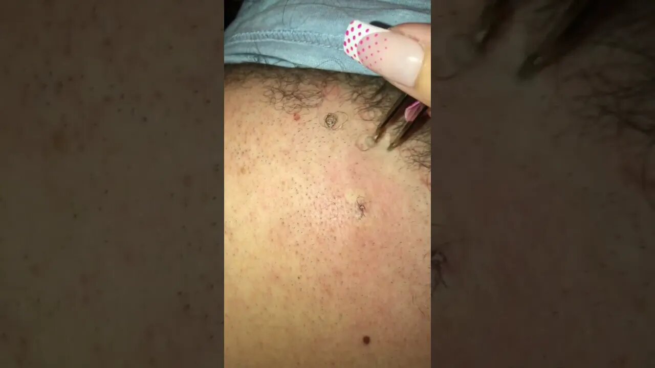 Enormous Ingrown Hair Removal