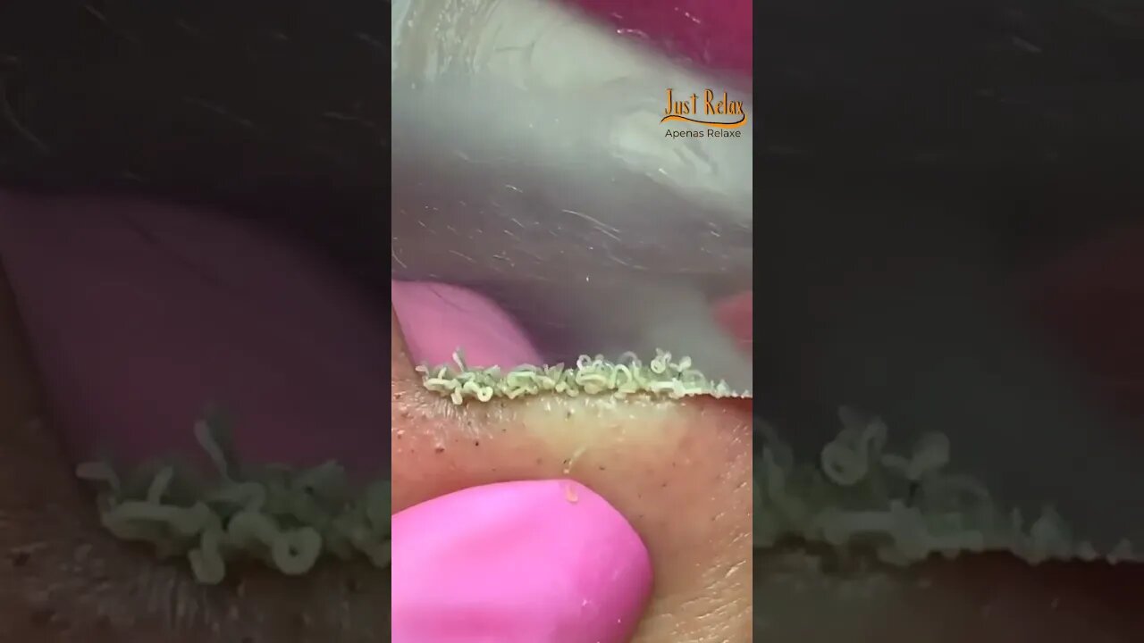 Satisfatório Remoção Cravos Peeling Ultrassônico - Satisfactory Blackhead Removal Ultrasonic Peeling