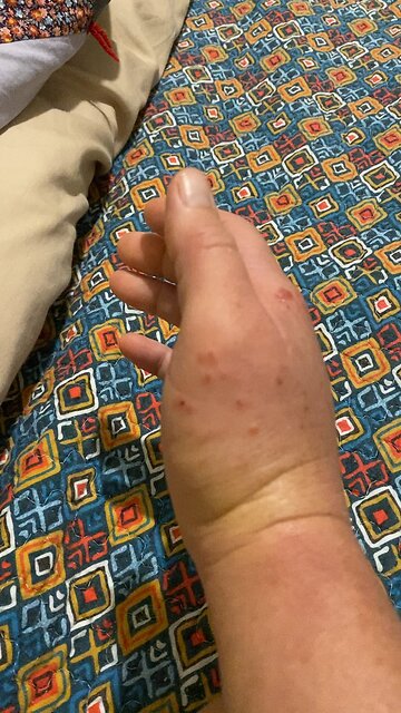 50 stings on rt arm from uncle rescue….