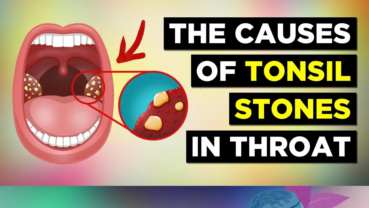 The REAL Cause of Tonsil Stones and Treatment