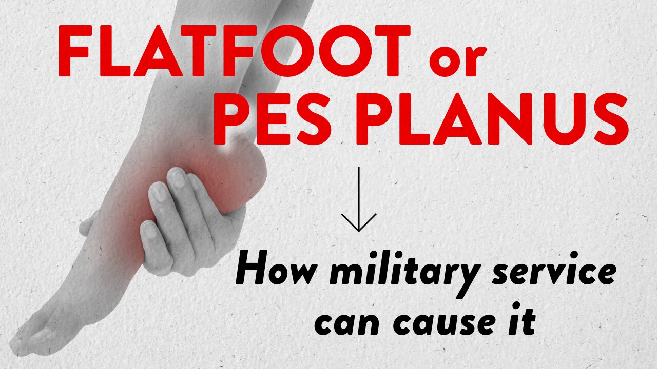 Flatfoot or pes planus: How military service can cause it