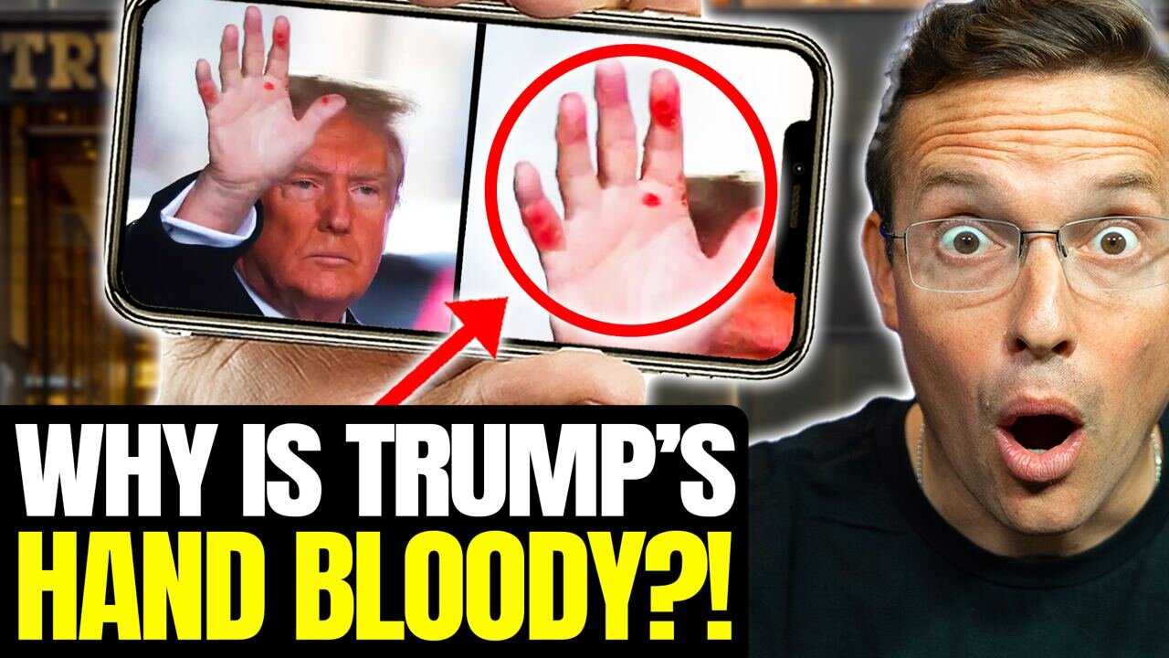 Trump Just Walked Out of Skyscraper With Red BLOODY Hand | What Is Going ON!? We Have The Answer 👀