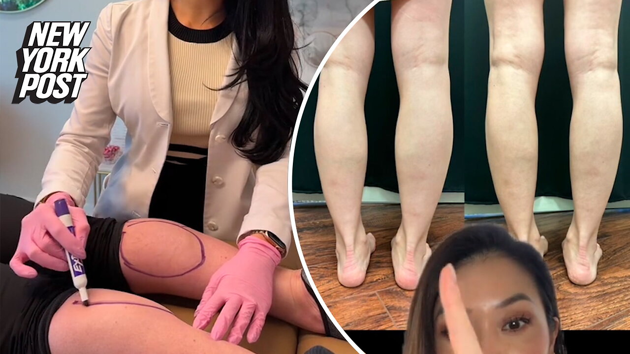 You've heard of Botox for wrinkles, but have you heard of "calf tox" to slim your calves? It's all the rage on TikTok