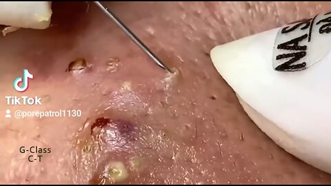 Massive Whiteheads Removal