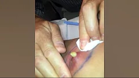 Exploding Nipple Cyst