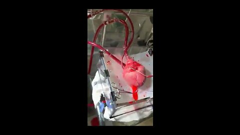 Open Heart surgery ♥️. #heart #rumble