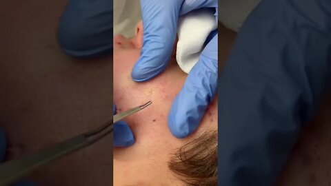 Limpeza de Pele Retirada de Cravos - Remoção de Cravos e Espinhas - Just Relax | Apenas Relaxe