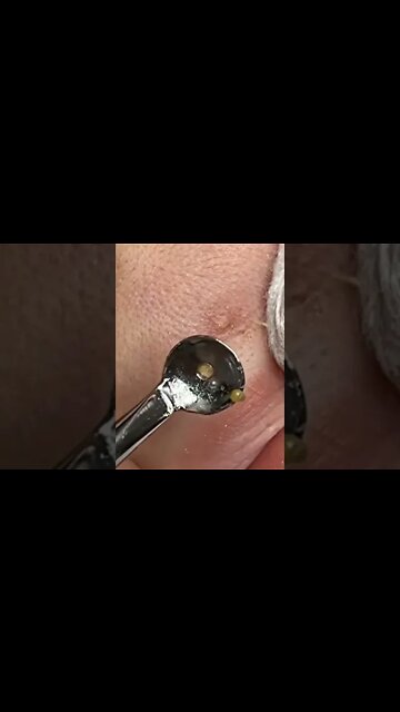 blackheads removal from the lips 🤗🤗
