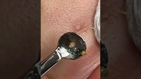 blackheads removal from the lips 🤗🤗