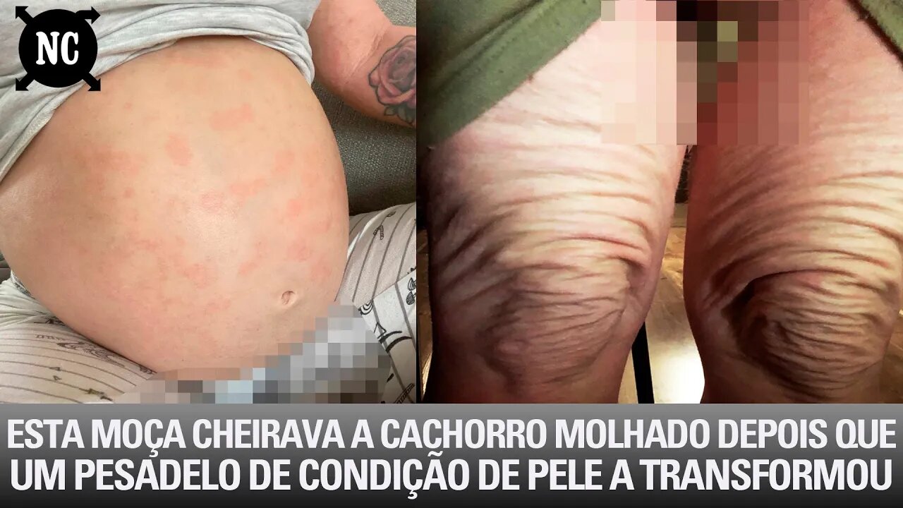 Esta Moça Cheirava a Cachorro Molhado Depois Que Um Pesadelo De Condição De Pele a Transformou