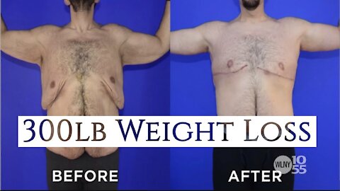 AMAZING 300 Pound Weight Loss Journey | Dr. Daniel Barrett | Plastic Surgery