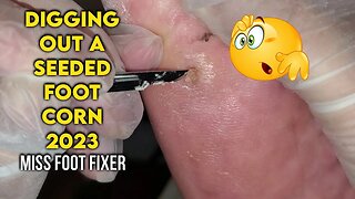 DIGGING OUT A DEEP SEEDED FOOT CORN 2023 | CORN TREATMENT BY FAMOUS PODIATRIST MISS FOOT FIXER