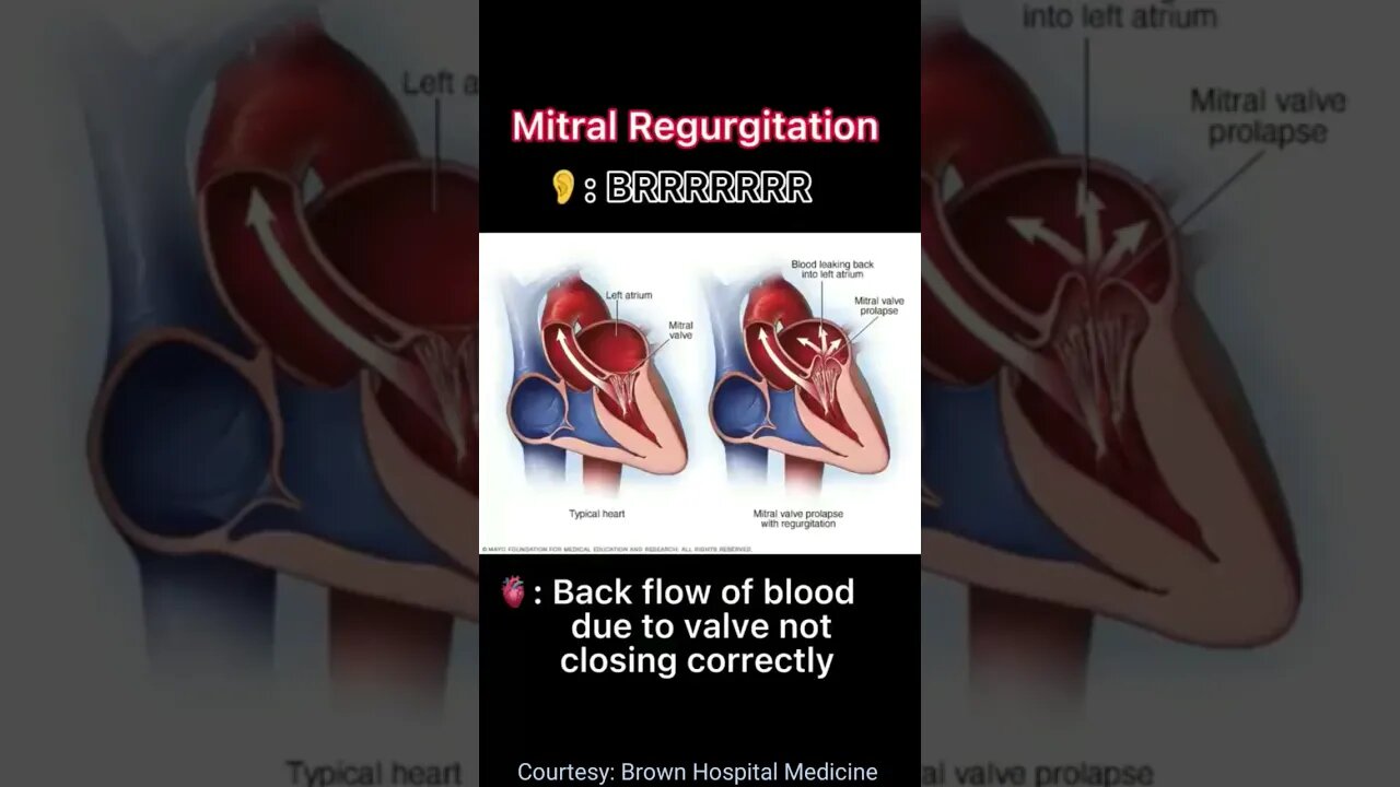 Heart Sounds | Normal & Abnormal | Dr Aamir Thazvi #shorts #heart #dr #medical