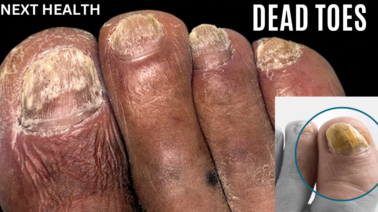 Rotten Nails and toes shocking!