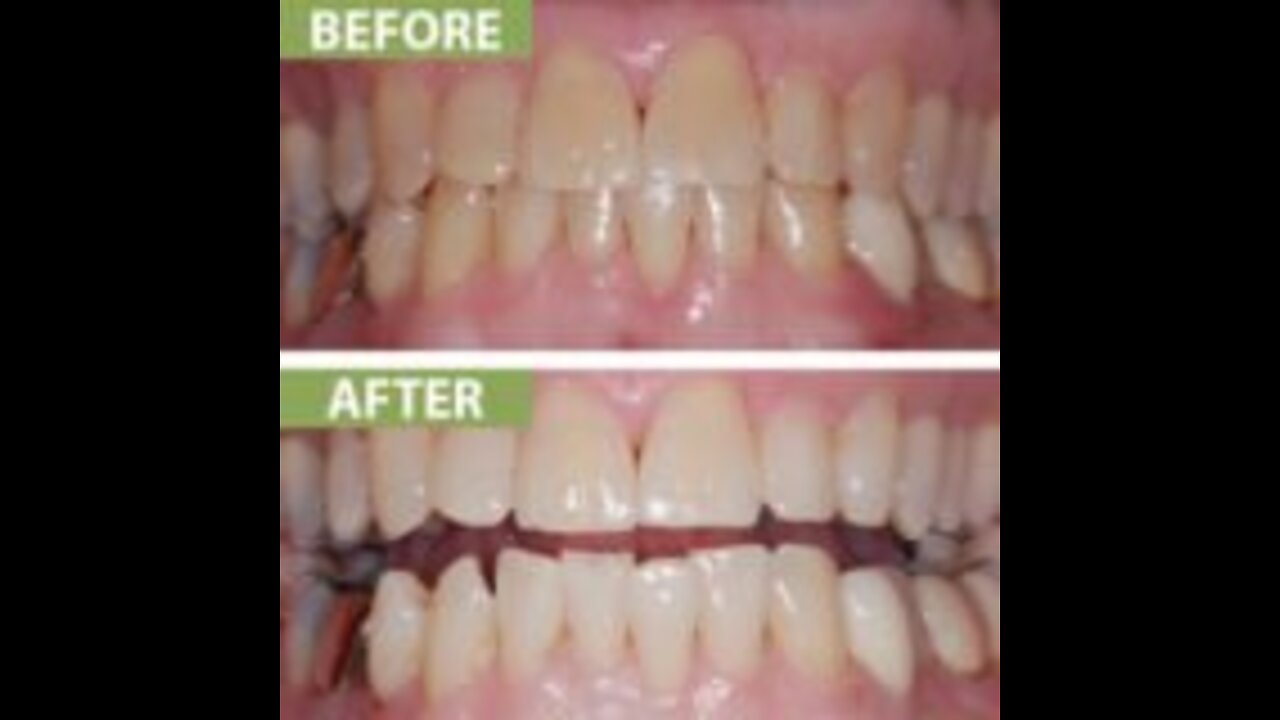 Veneers Yakima | 509728932 | tewdental.com