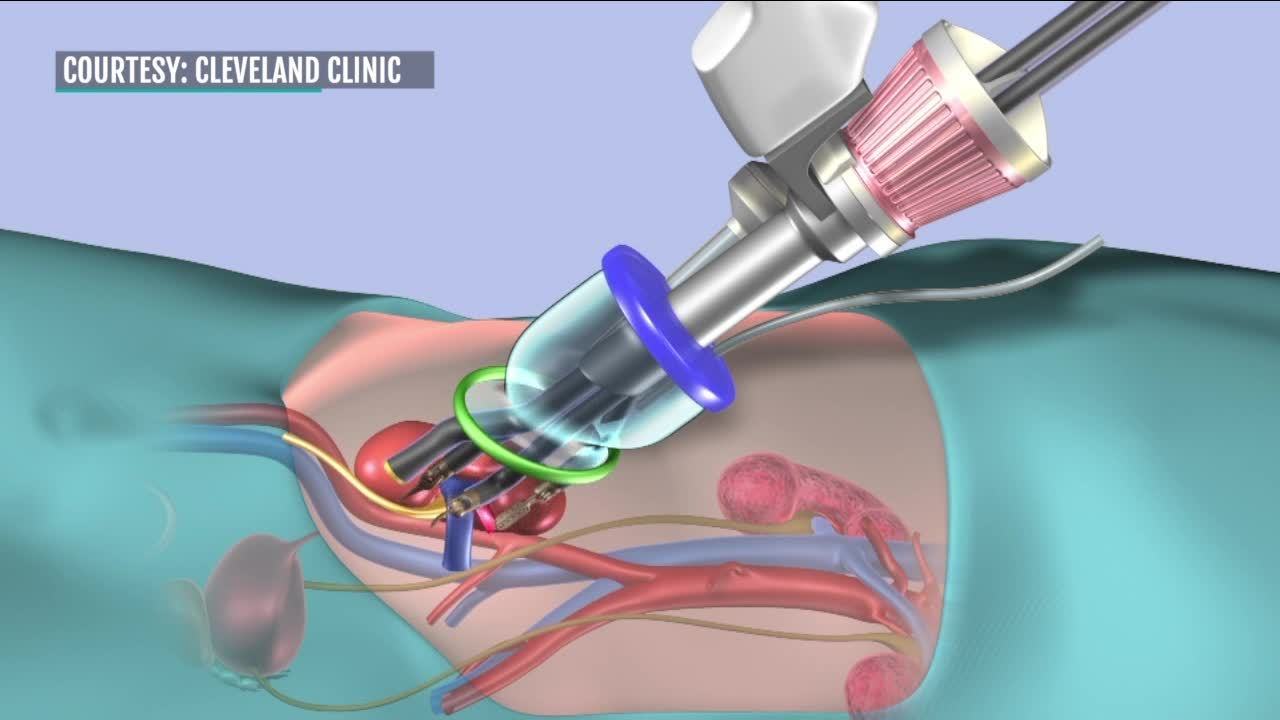 A robotic single port kidney transplant has been successfully performed at the Cleveland Clinic, a first in the world