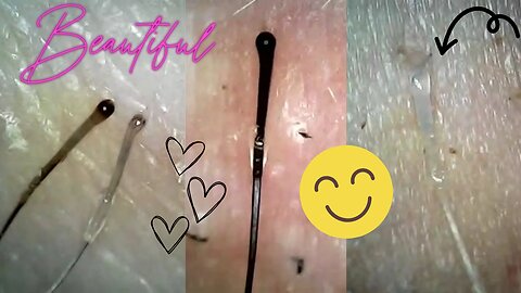 Big Roots & Sheaths Hair Follicle Plucks! Ingrown Hair Removal Under Microscope! Super Satisfying