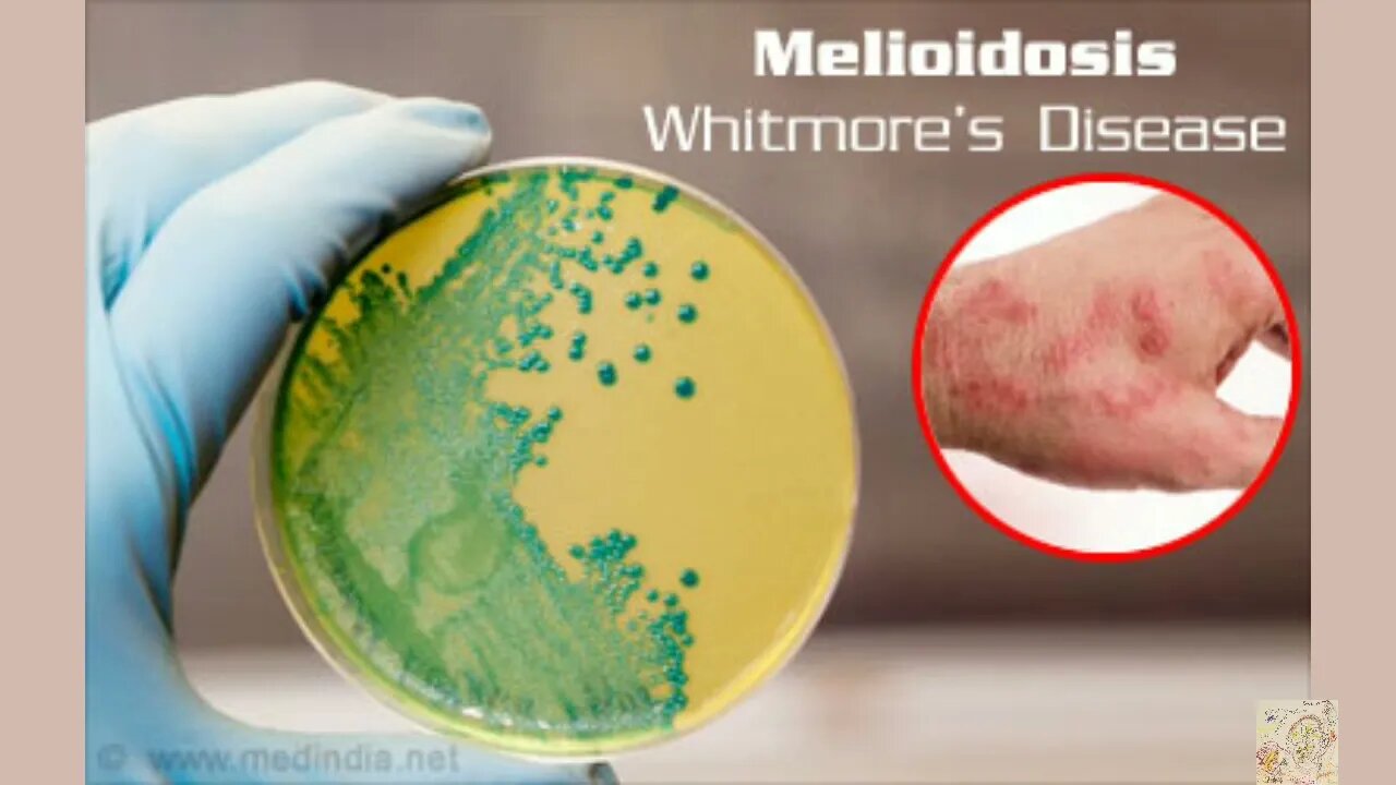 Melioidosis-Warning From The CDC