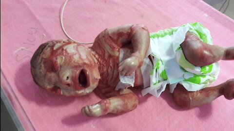 Fauci Cut Feeding Tubes Into Black Orphans To Force Deadly Medical Experimentation